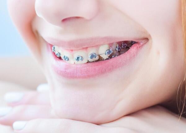 佩戴牙齒矯正器 成人聲波電動牙刷使用禁忌1